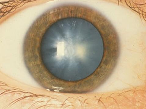 白内障可诱发青光眼切勿拖延治疗