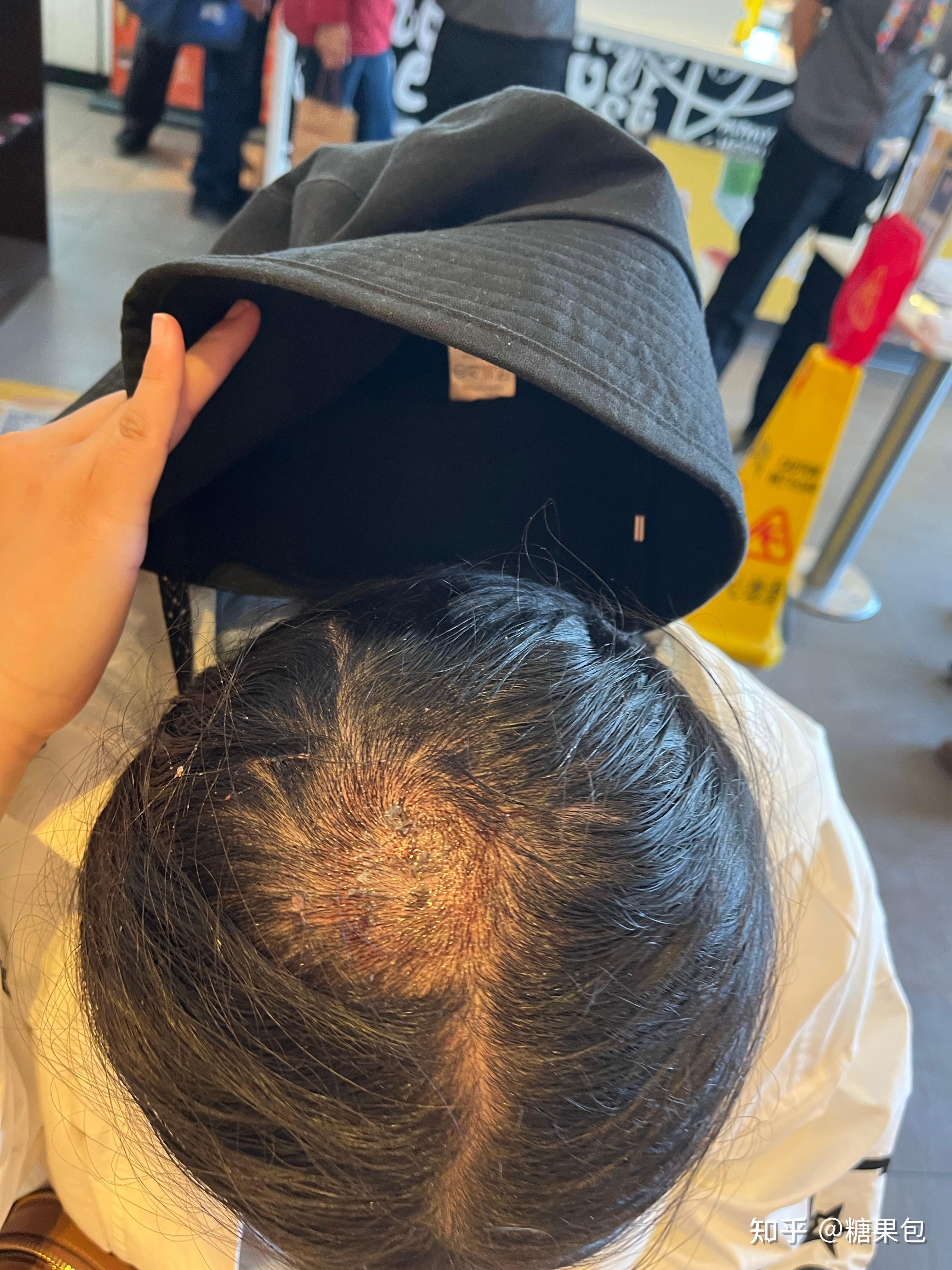 头皮上长了一个红色的小肉球不疼不痒的问一下是啥