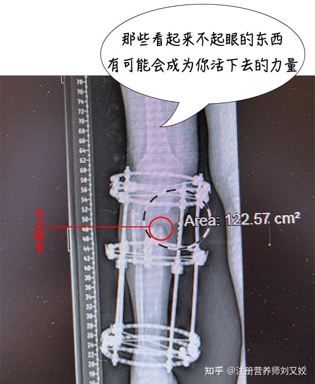 德国男子连做 2 次断骨增高至 1 米 9,靠谱吗?存在哪些健康风险?