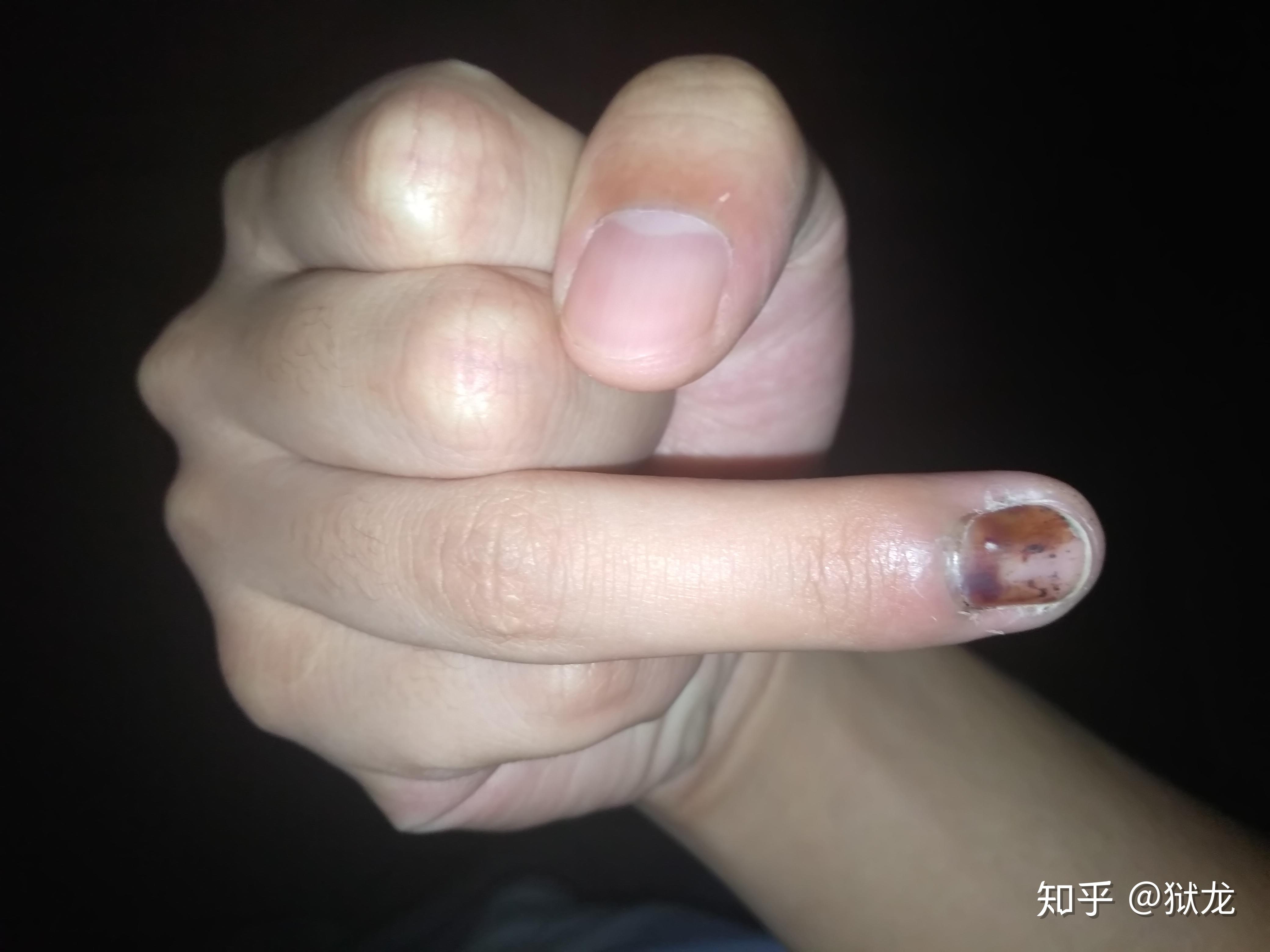 手指甲被夹到,过了一段时间,有黑色的淤血,怎么处理? - 知乎