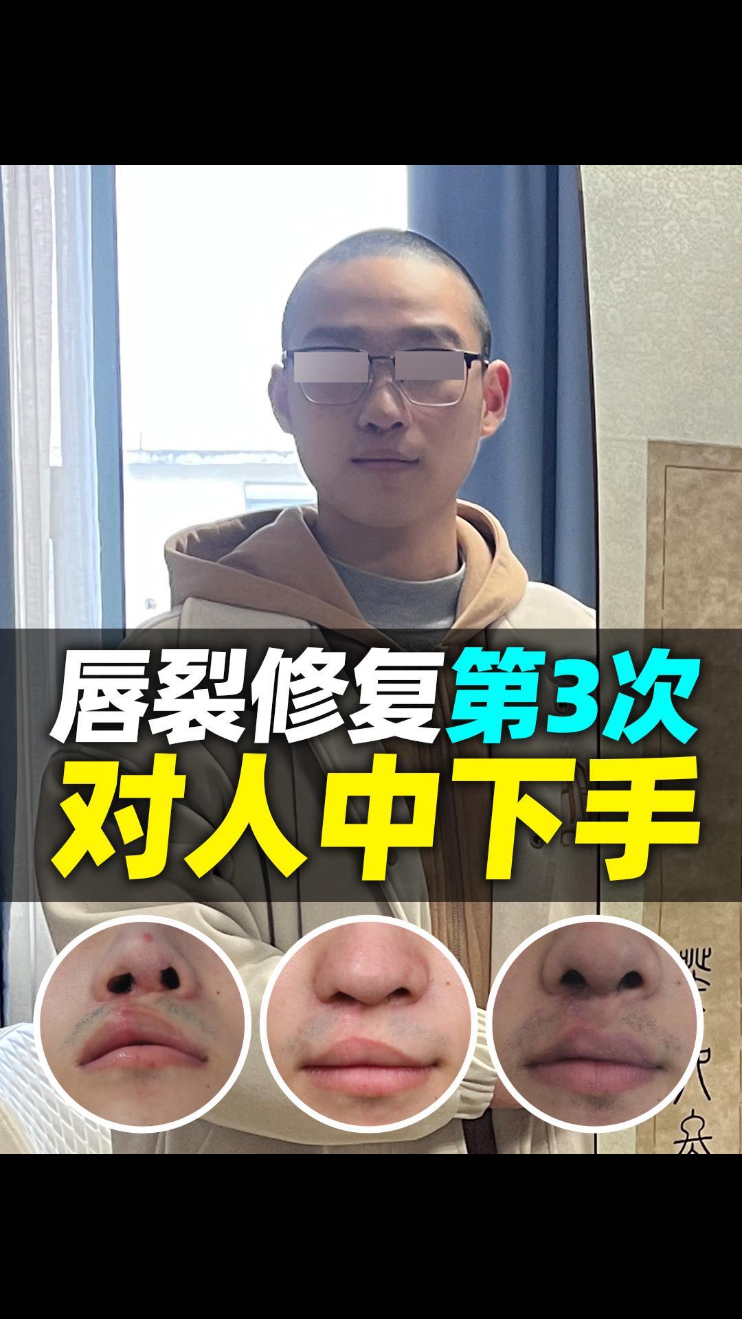 唇裂修复第三次对人中"下手" 了!