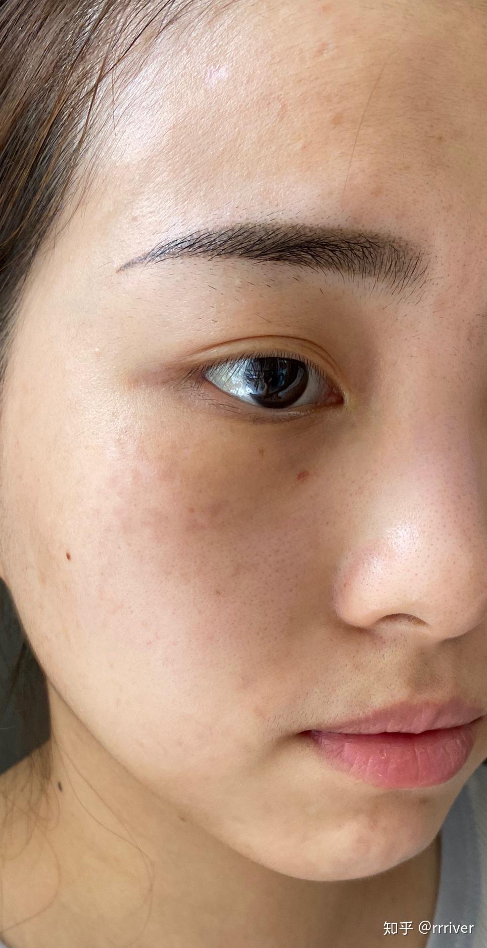 有谁褐青色痣治好过? - 知乎