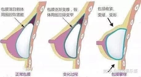 隆胸