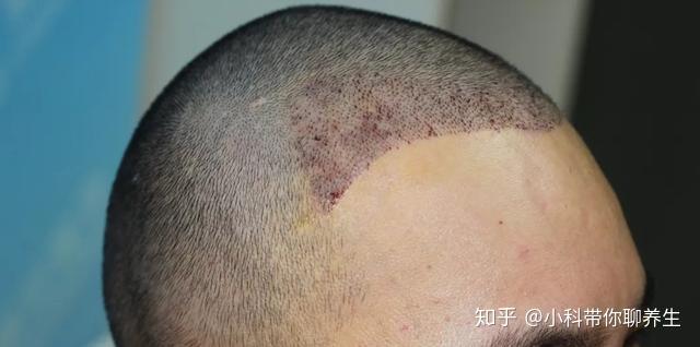 种植完头发后,对于“血痂”问题该怎么应对呢? - 知乎