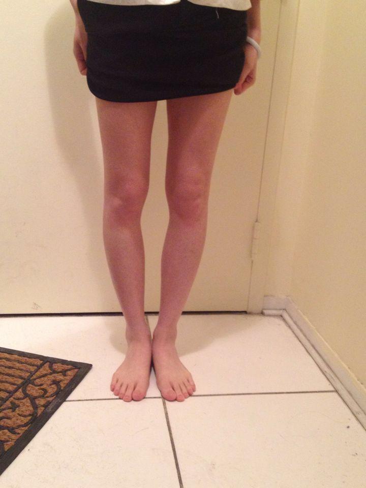 o型腿的人为什么跑不快?而且感觉很费劲