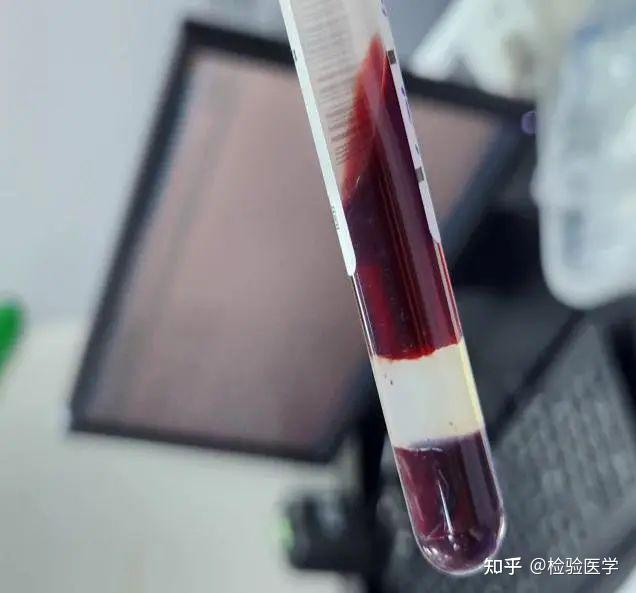 标本严重溶血惹的祸？一例慢性肾衰合并横纹肌溶解症诊断的思考 - 知乎