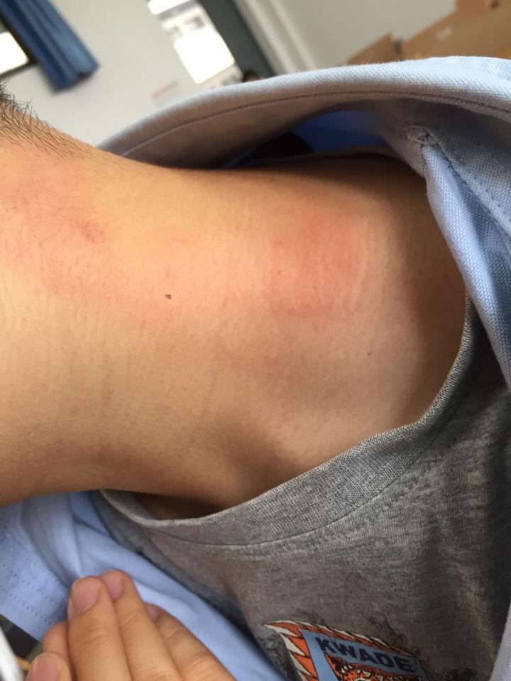 隐翅虫造成的伤口有什么特点? - 知乎