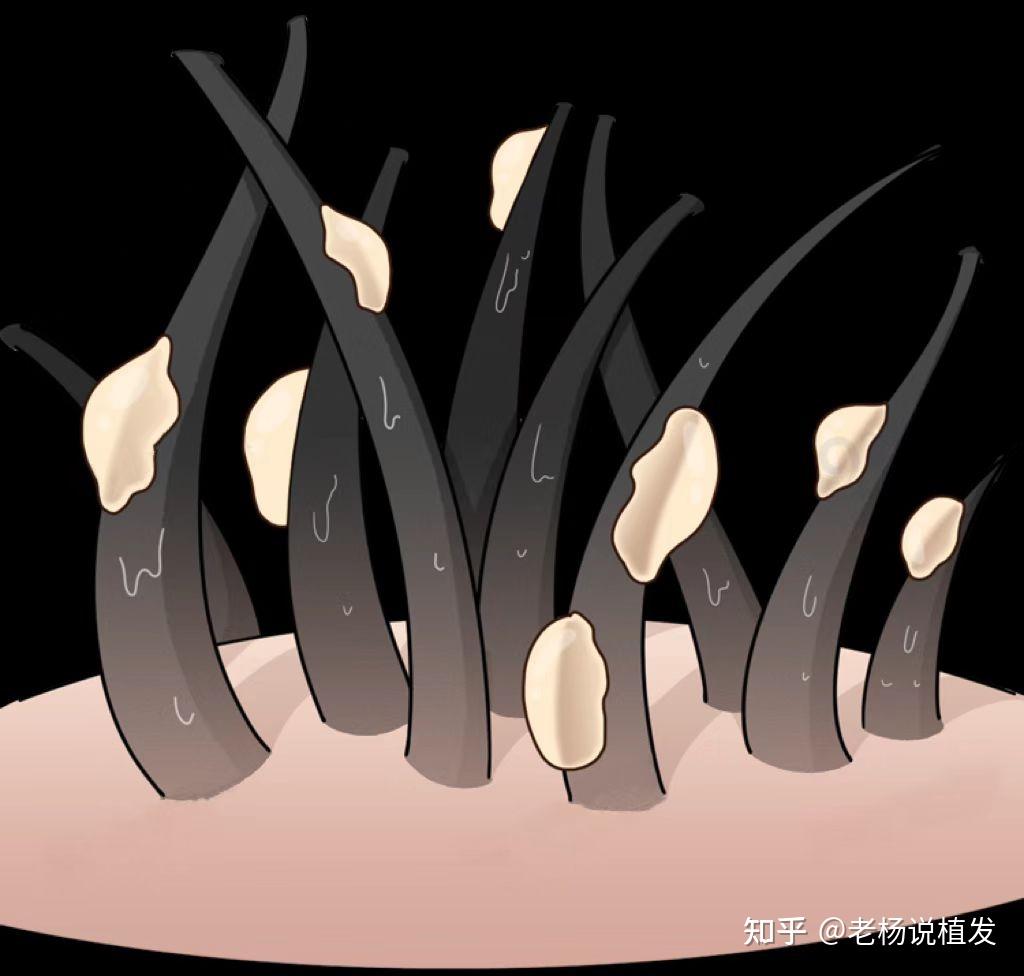 头皮总爱出油怎么回事? - 知乎