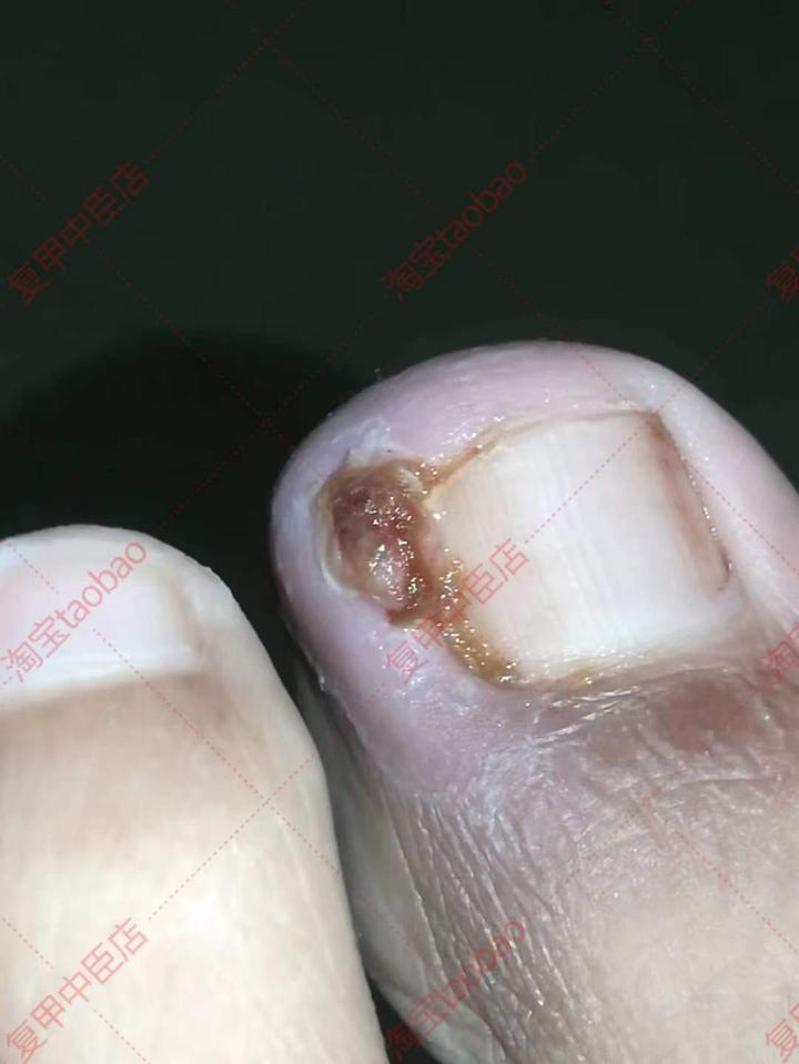 脚趾甲长到肉里怎么办