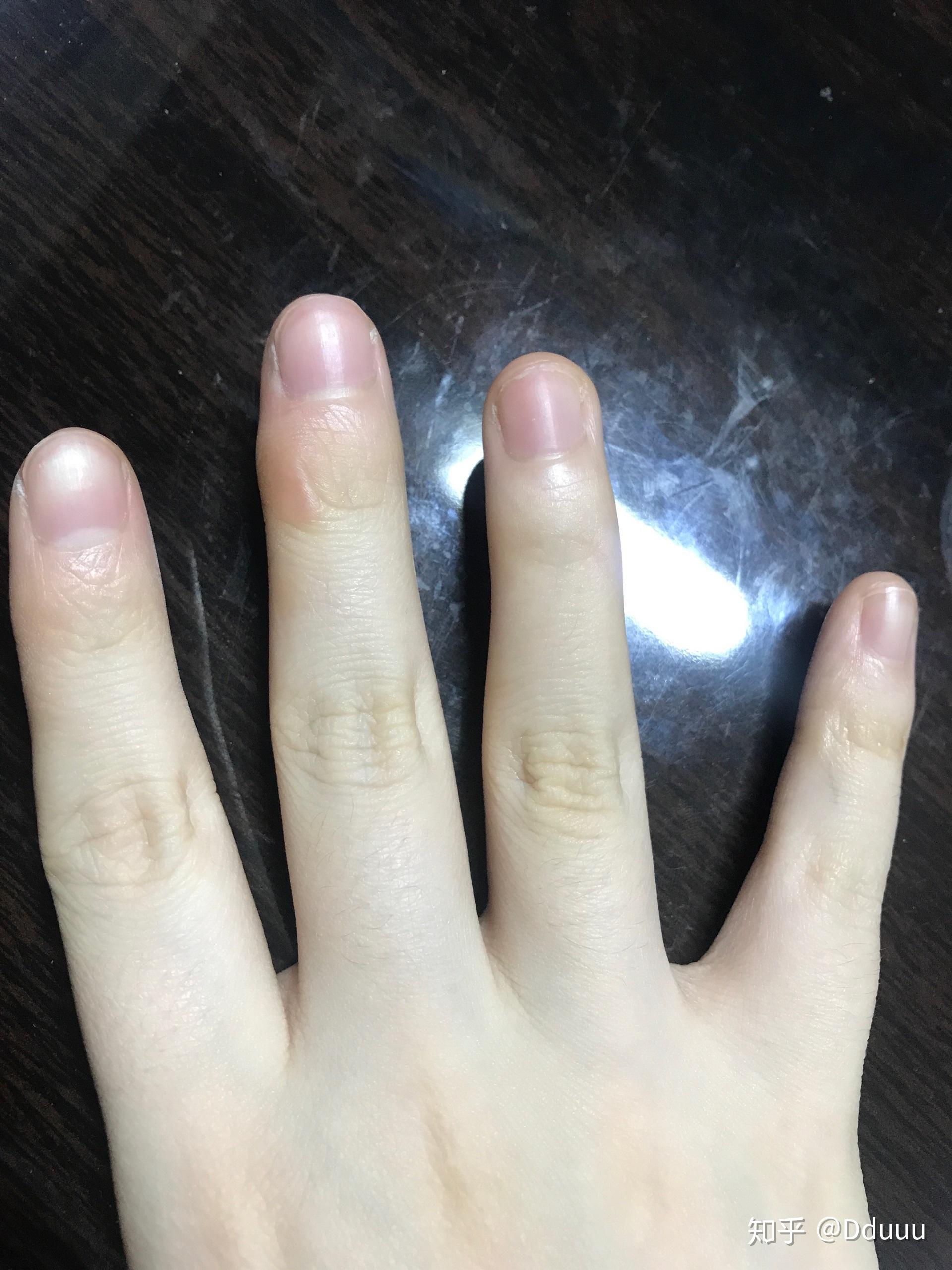 小时候握笔姿势不正确导致手指变形怎么办