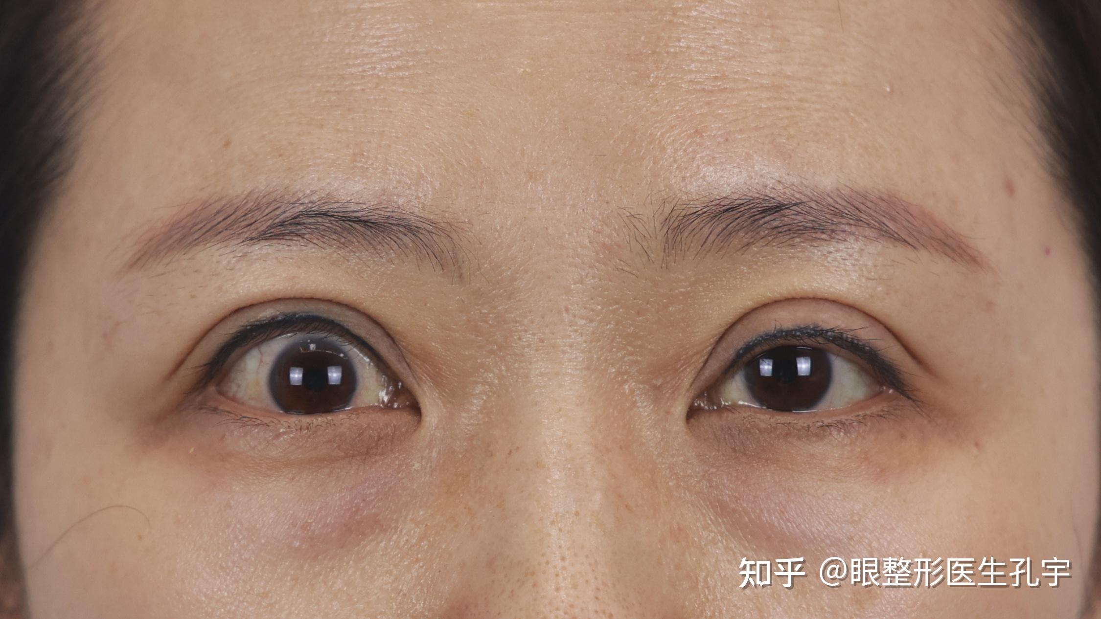 甲状腺眼病导致的上眼睑退缩如何改善? - 知乎