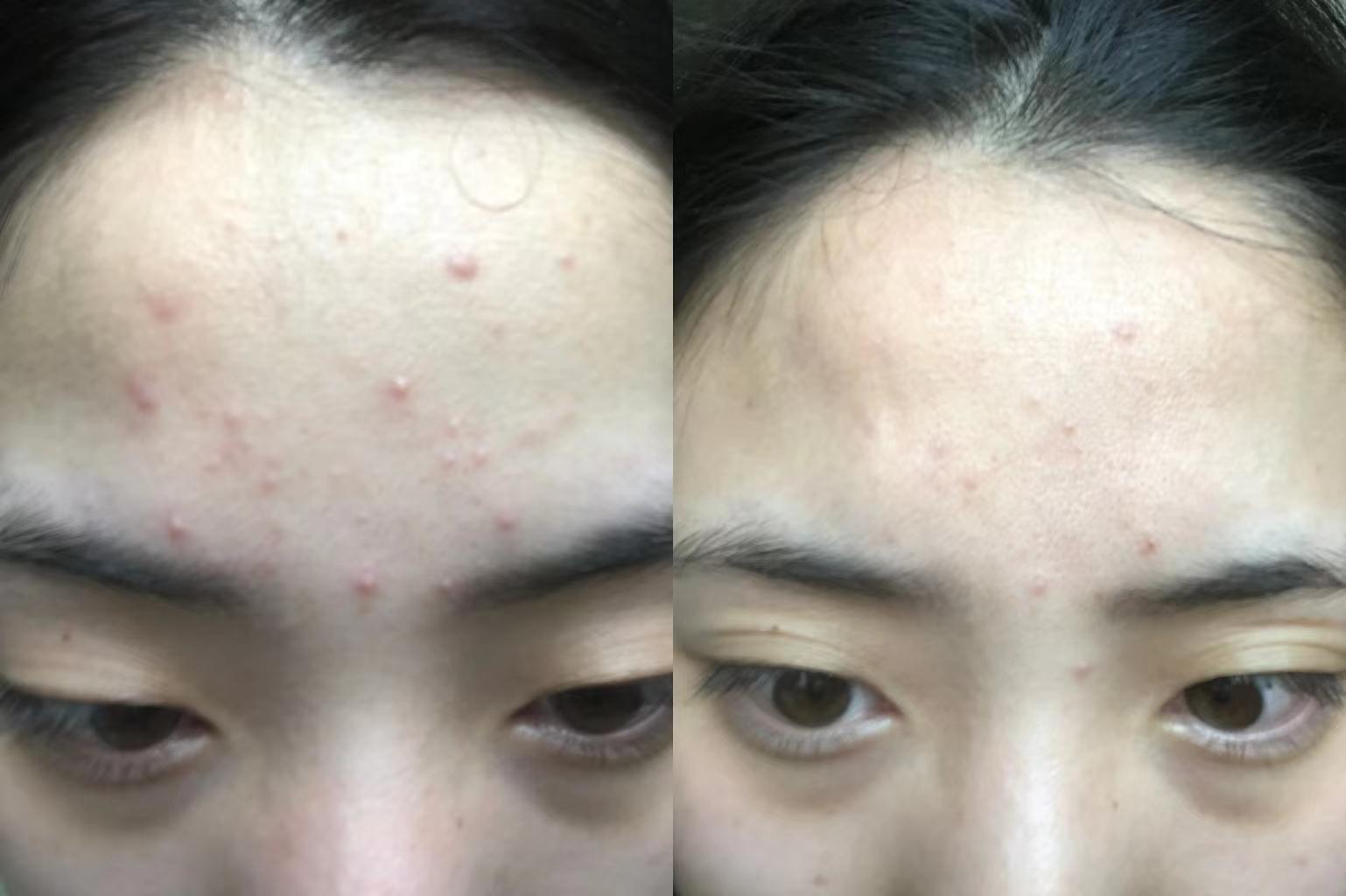 面对痘痘痘印,到底哪种祛痘方法好用?(真实案例分享与方法推荐)