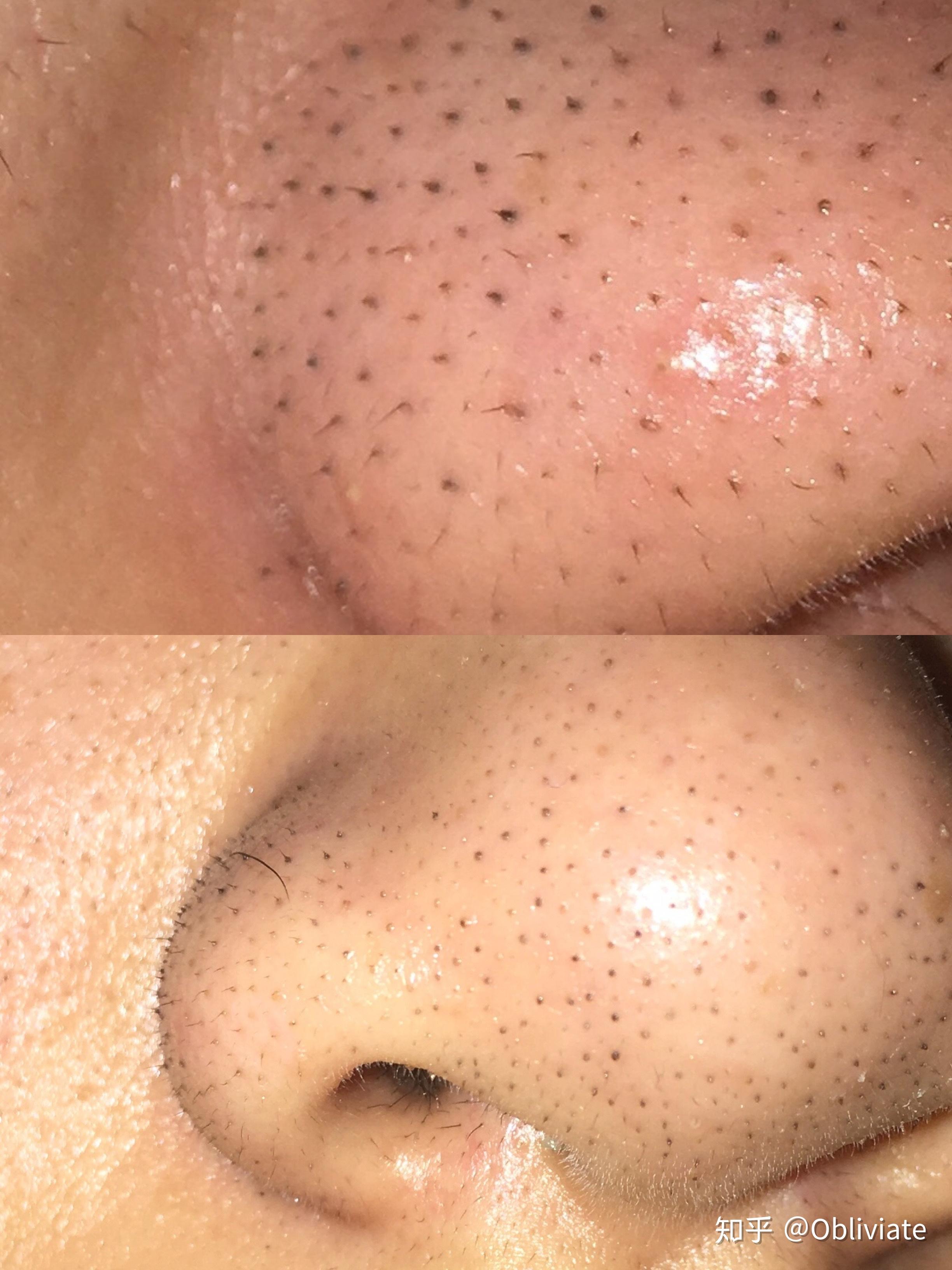 这样的黑头 怎么办啊? - 知乎