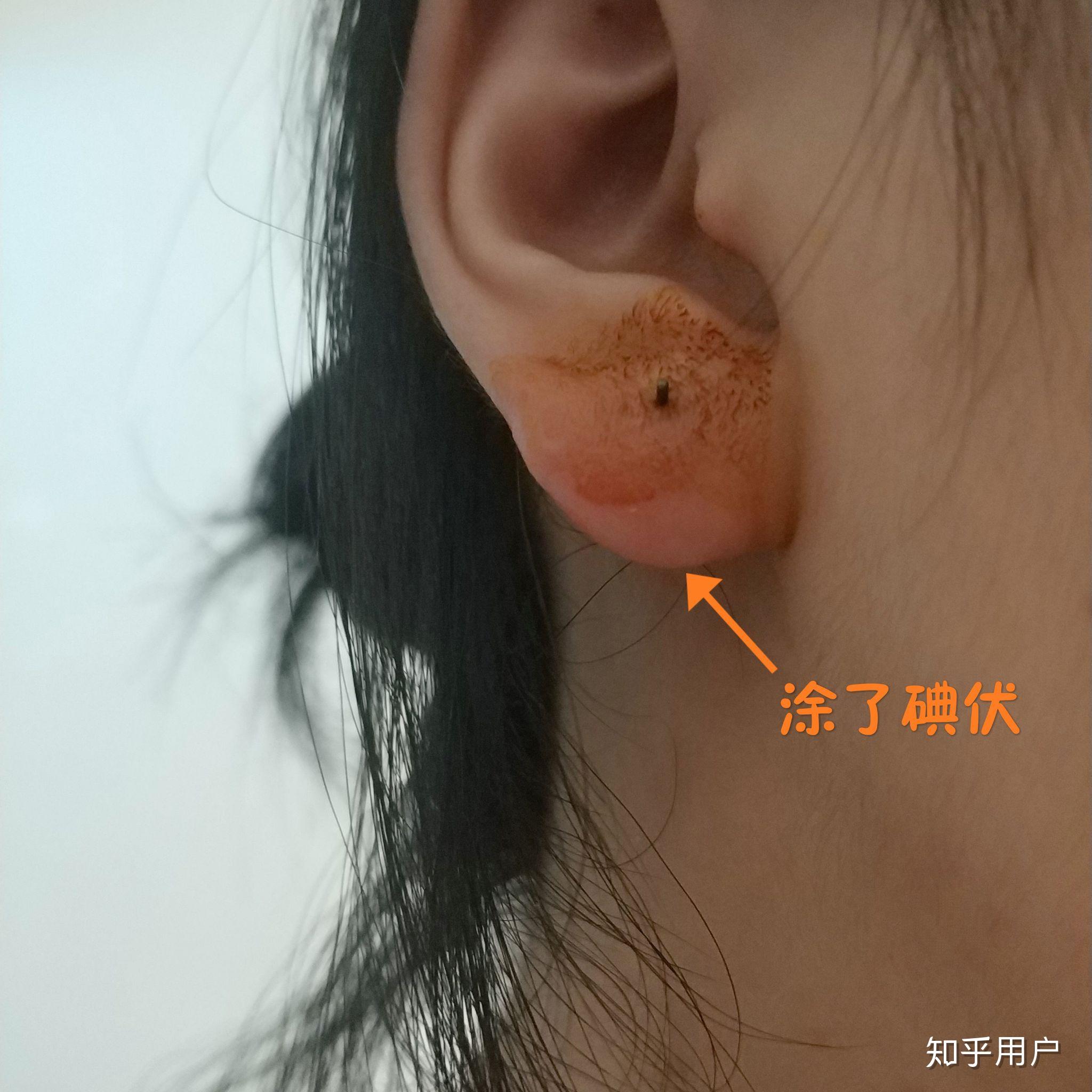 耳洞堵了耳垂肿了有硬块会消除么消除了之后还能再打么