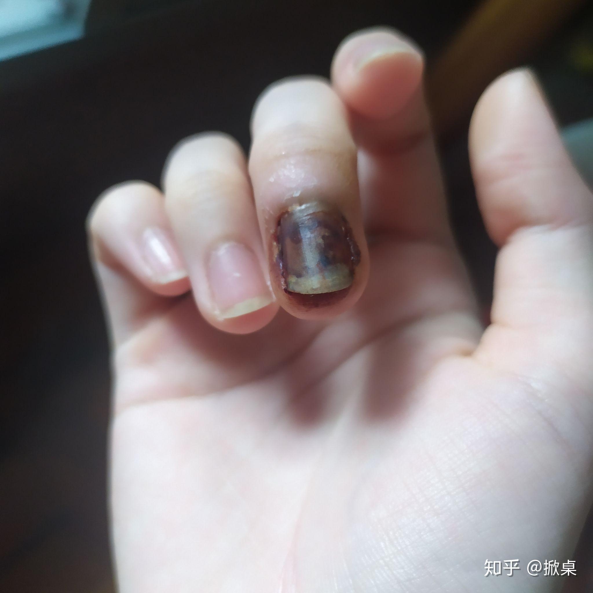 手指被门夹伤后的康复过程记录 - 知乎