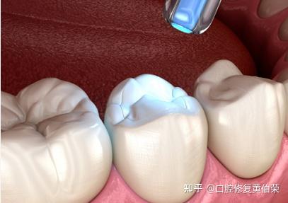 补牙、镶牙和种植牙三者有什么区别? - 知乎