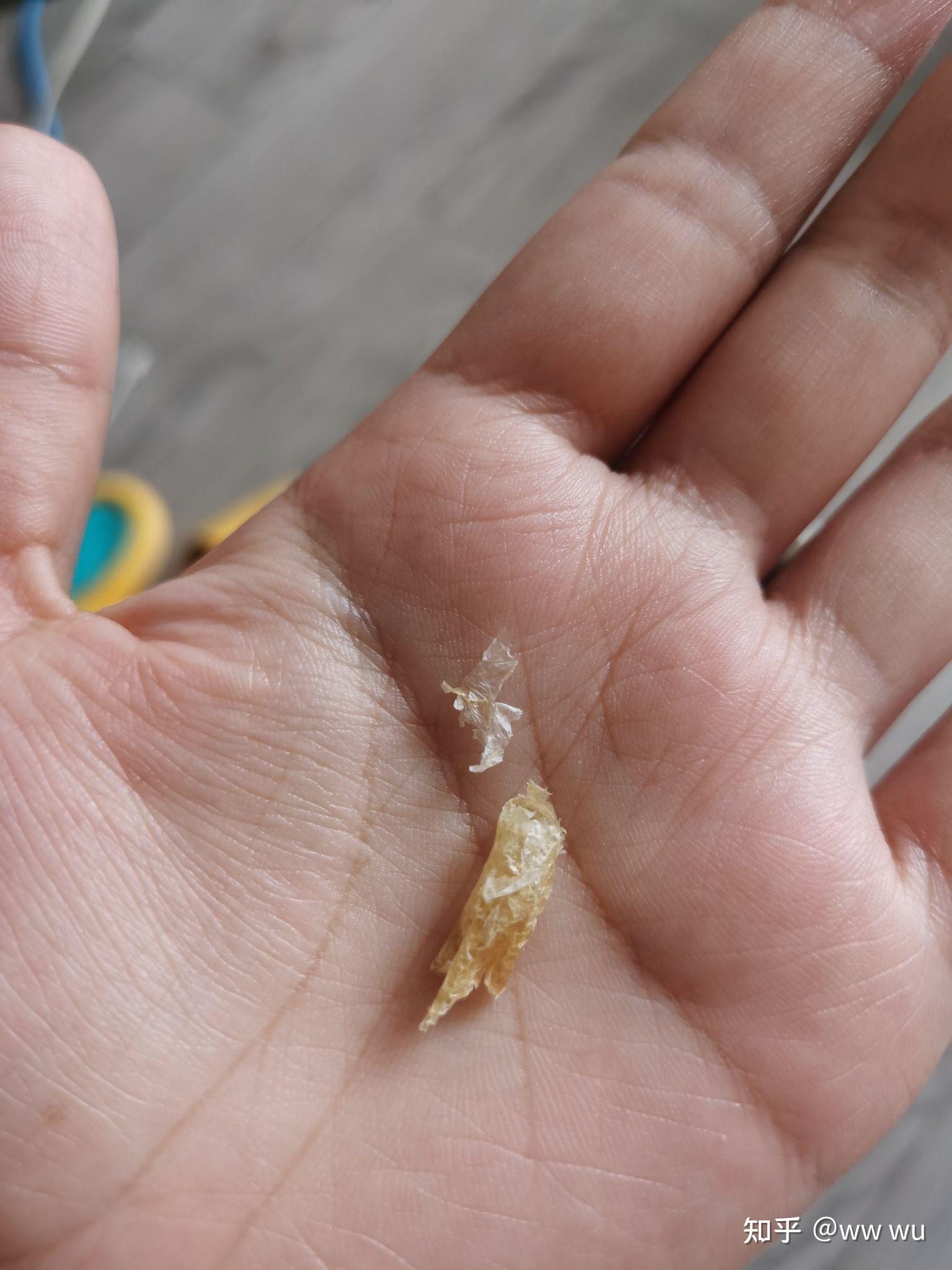 为什么我掏出来的耳屎是桶状的就是一层薄膜粘附在耳壁上