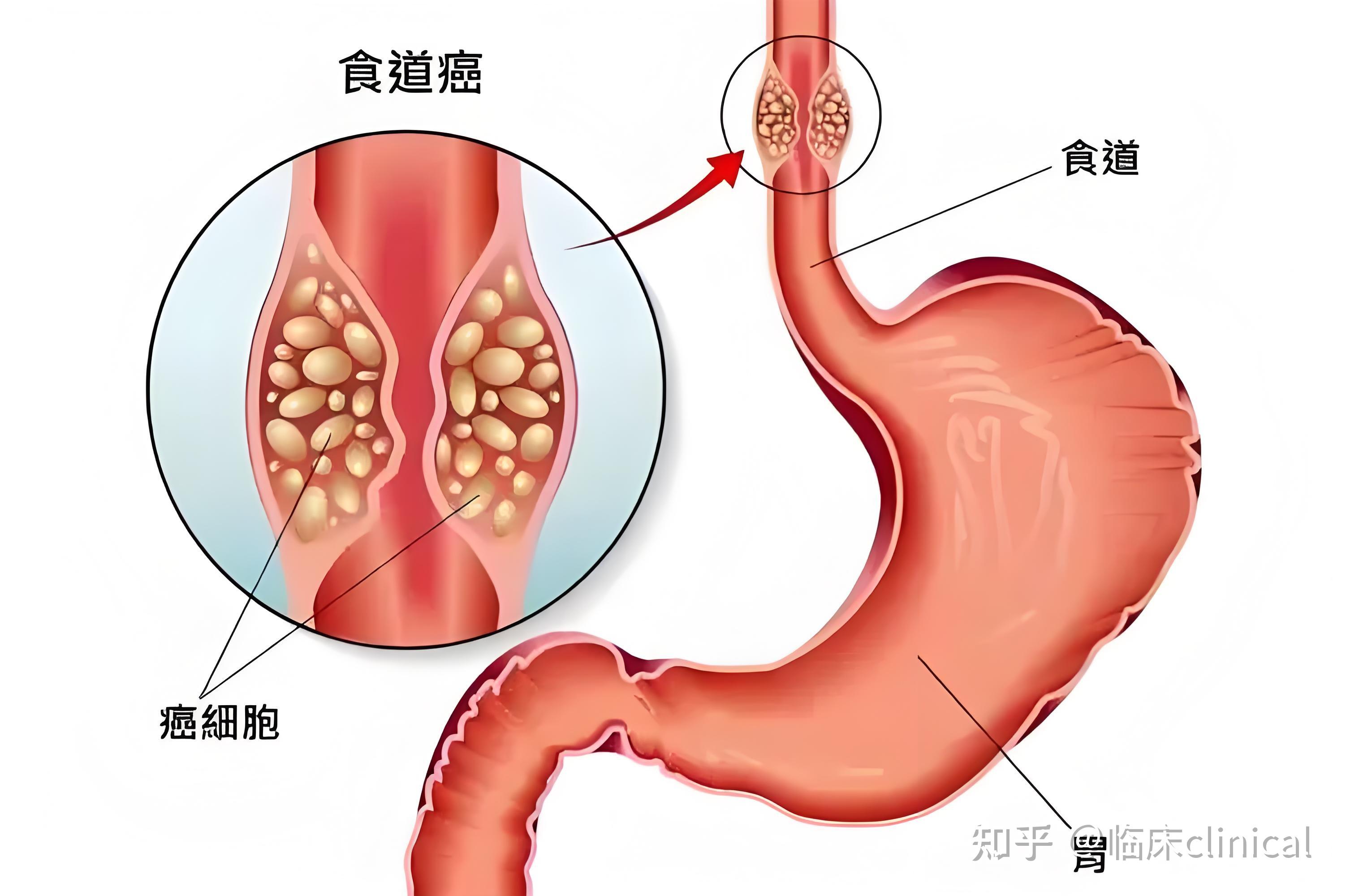 食道癌的早期症状和前兆是什么?