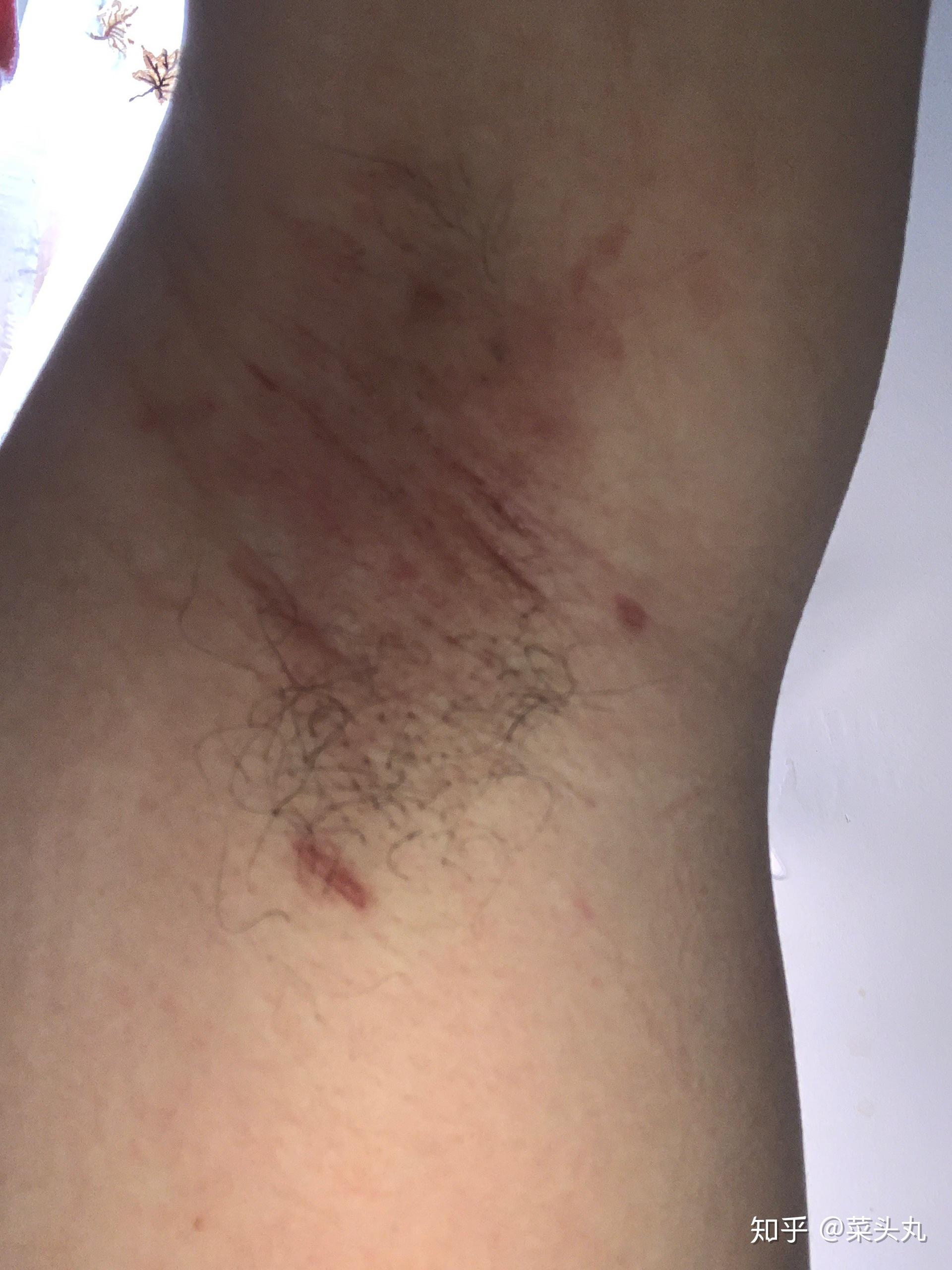 做腋下大汗腺切除手术是什么体验