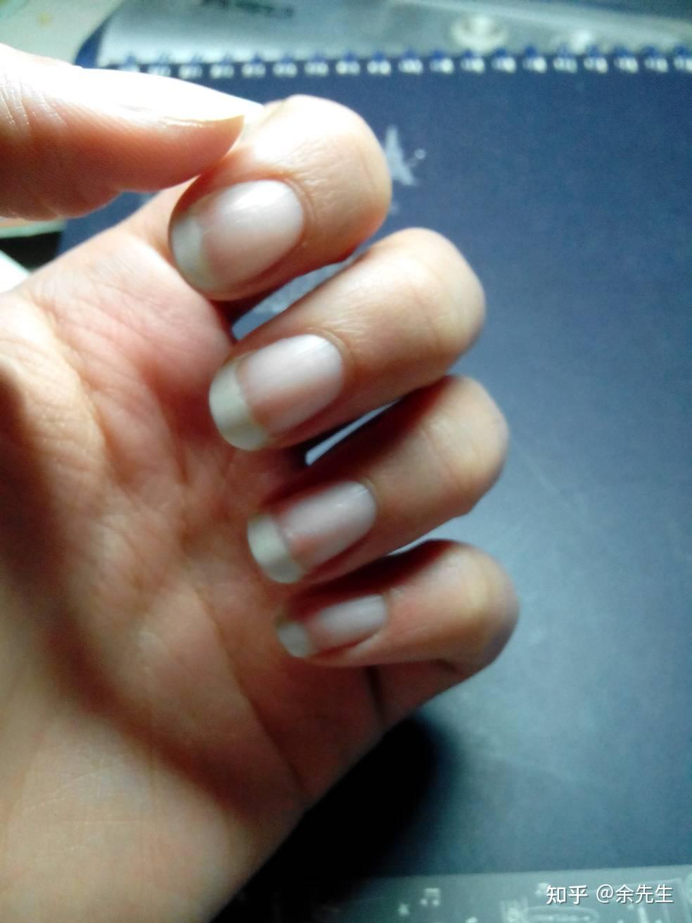 手大拇指指甲中有一块白了是什么原因? - 知乎