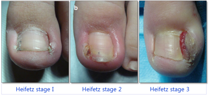嵌甲的严重程度分级