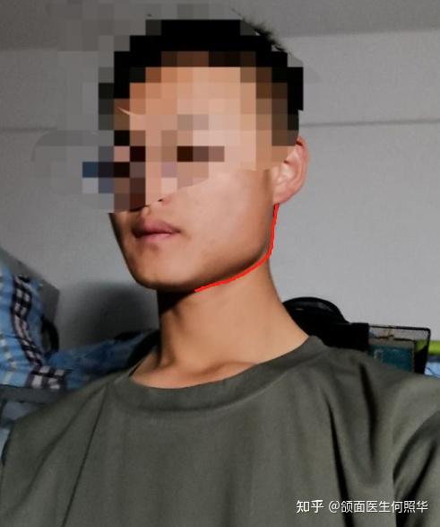 咬肌大骨骼也大怎么办救命