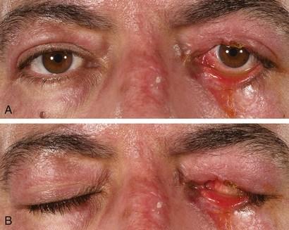 眼睑烧伤的晚期并发症——烧伤挛缩引起的睑外翻和兔眼症应对方案.