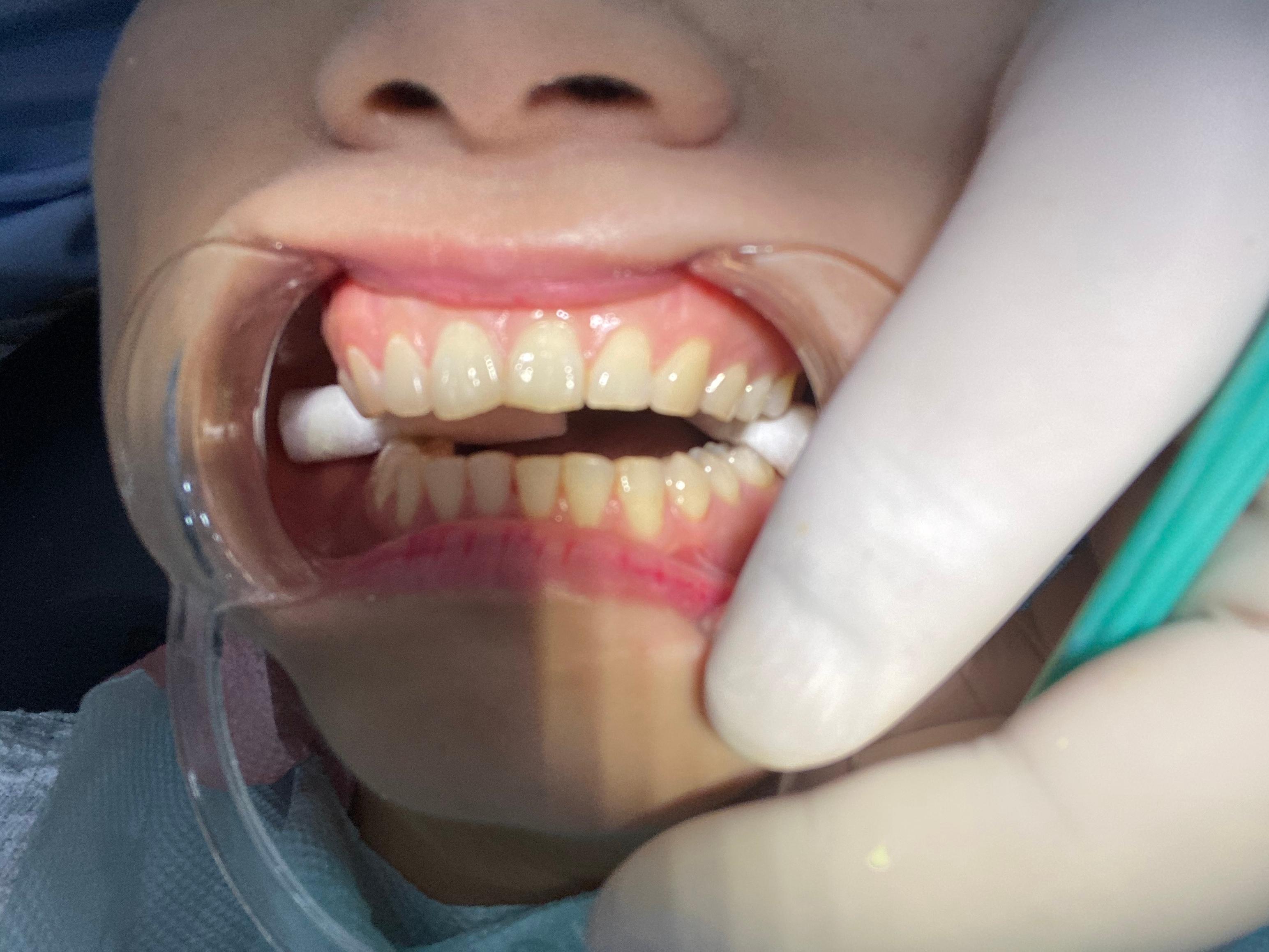 有什么方法可以让牙齿变白