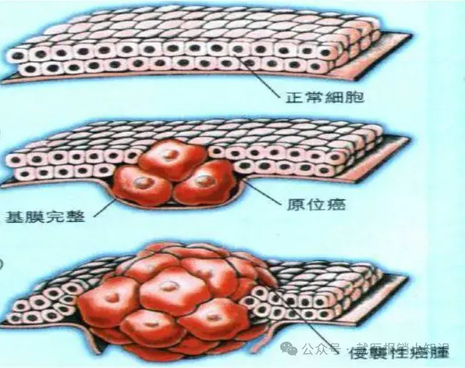 原位癌与原发癌的联系与区别 - 知乎