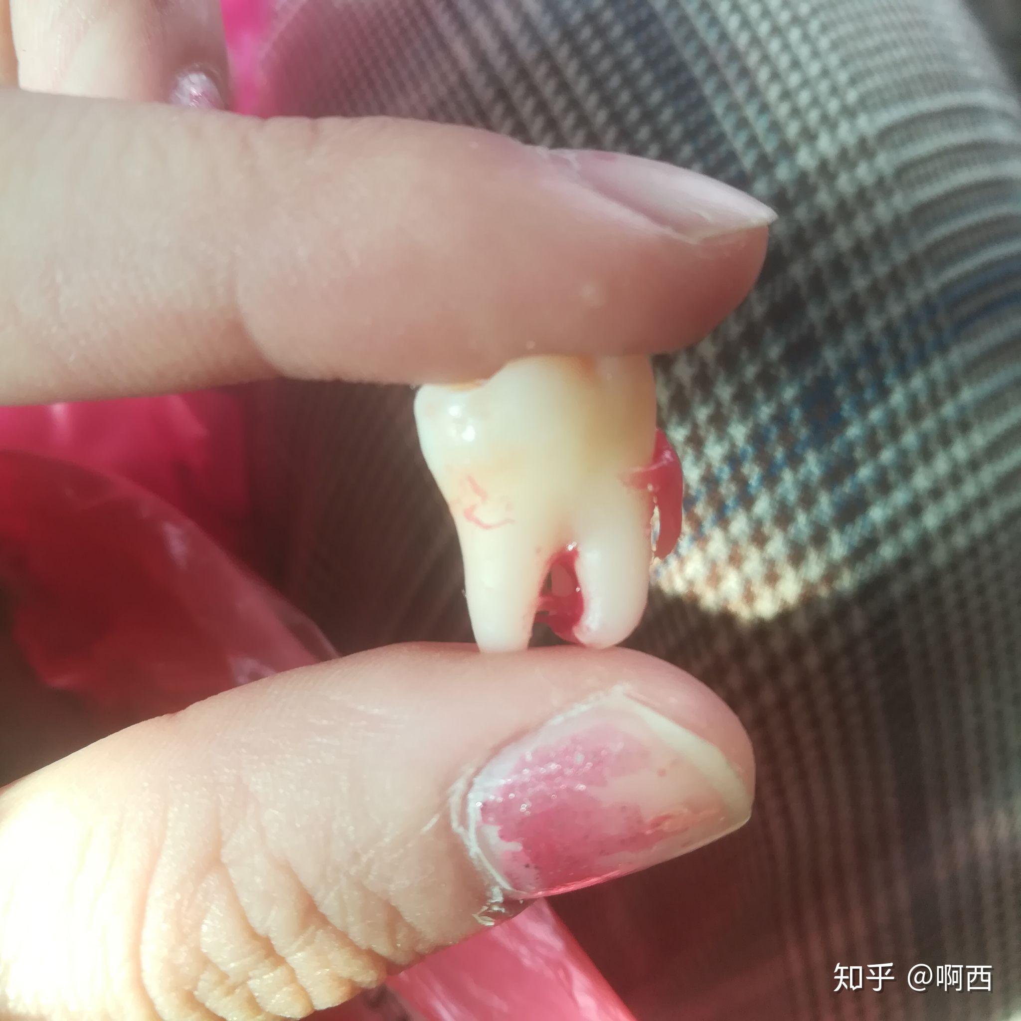 长了四颗阻生智齿是什么样的体验