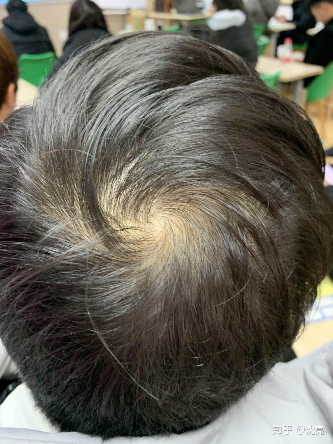头顶漩涡头发少是什么原因? 