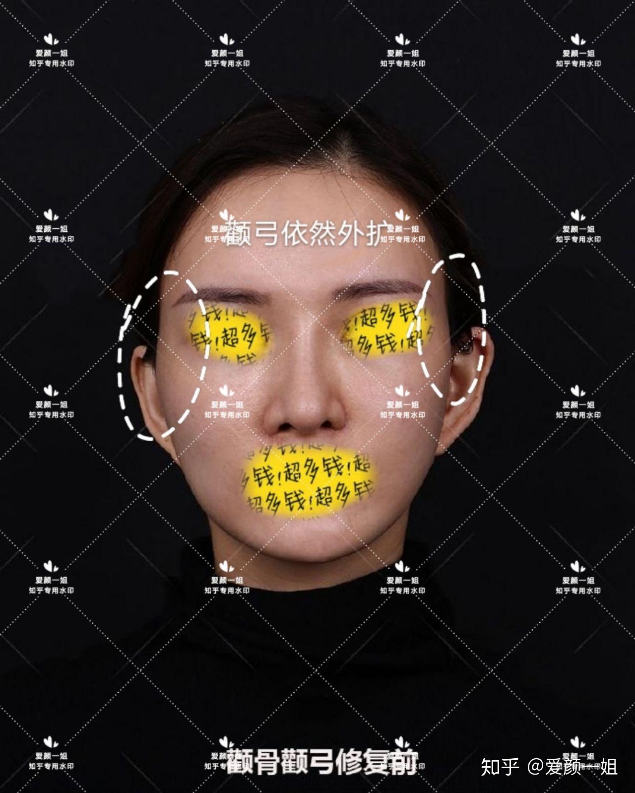 教你看ct【失败】这个准备做颧骨颧弓修复的！常问吉玟锡、杨君毅、郑康在、河东镐、王珍祥、刘祥夏、沈绍勇 - 知乎