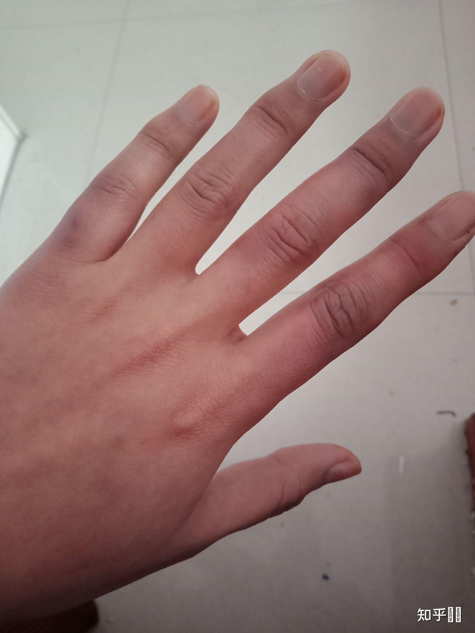 冬天手冻了,指节变粗了,变形了怎么办? - 知乎