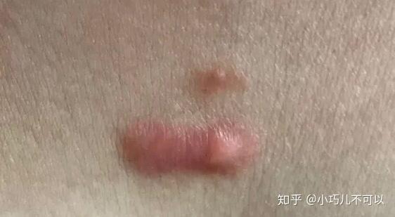 我女朋友胸前有个瘢痕疙瘩,有什么好的治疗方法吗?