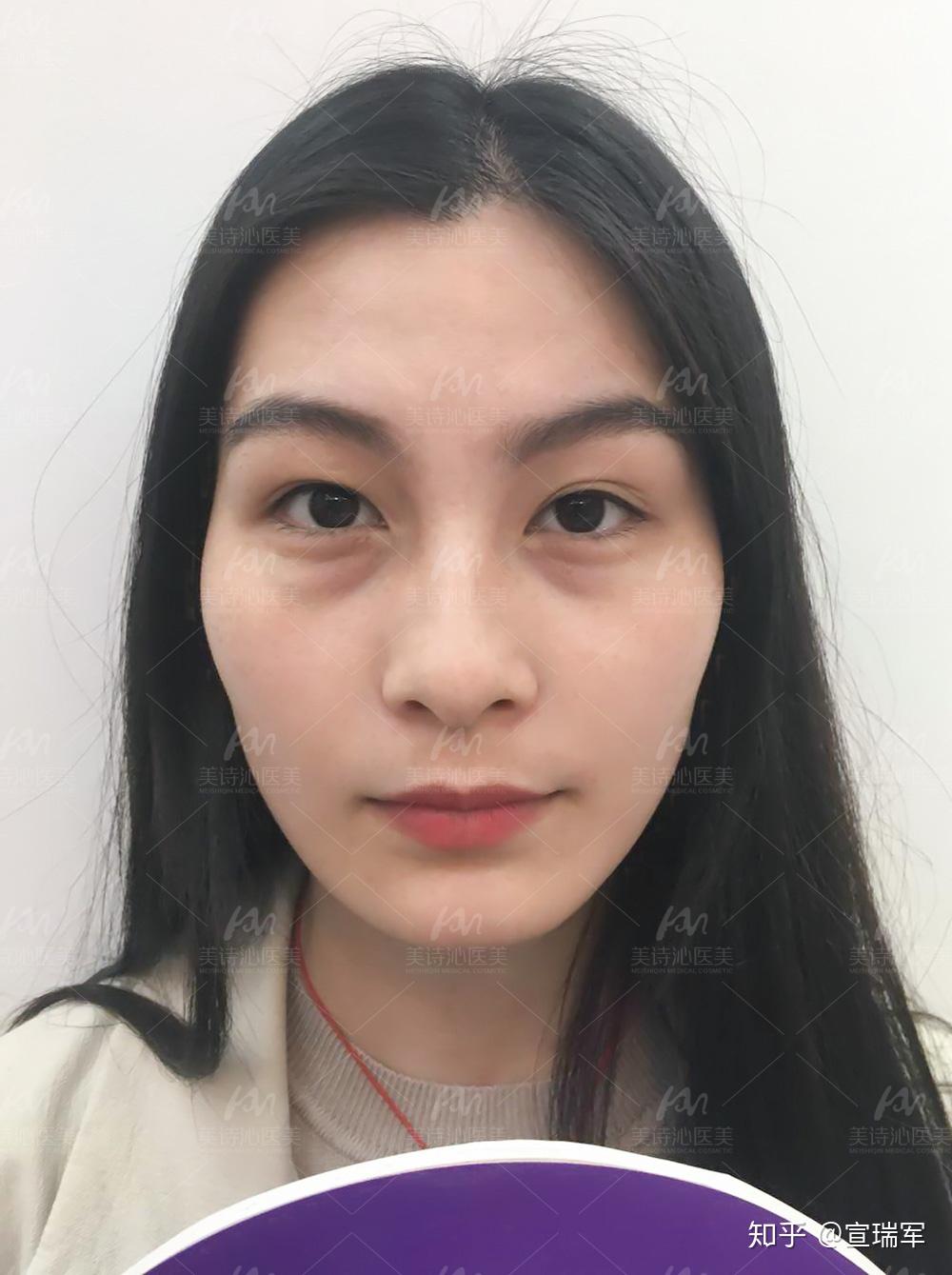 突然间有眼袋了怎么办