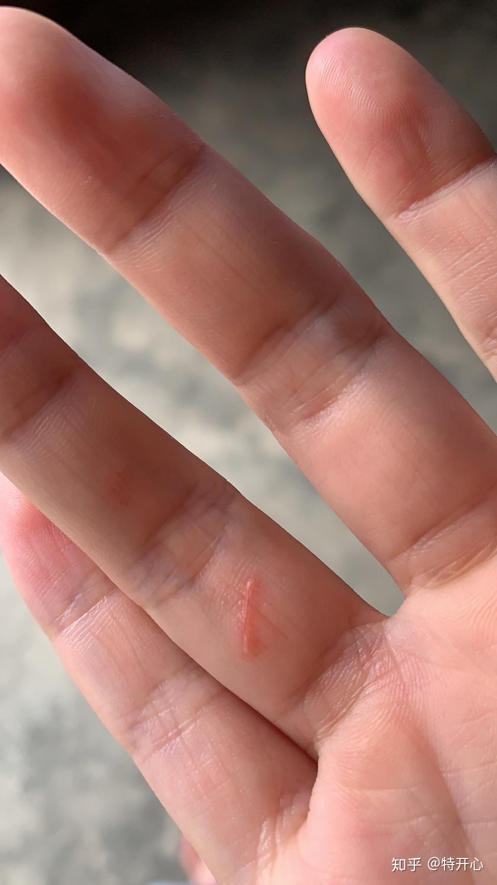 被三个月的小猫咬破手指出血了要打狂犬疫苗吗