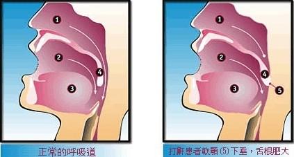 当你有一个爱打呼噜的室友你该怎么办