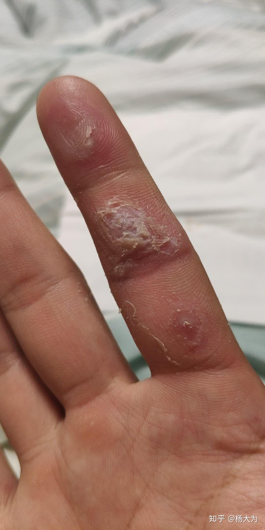 手上长了瘊子该怎么治疗求帮助