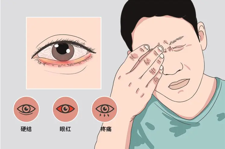 眼科专家讲解什么是睑板腺 - 知乎