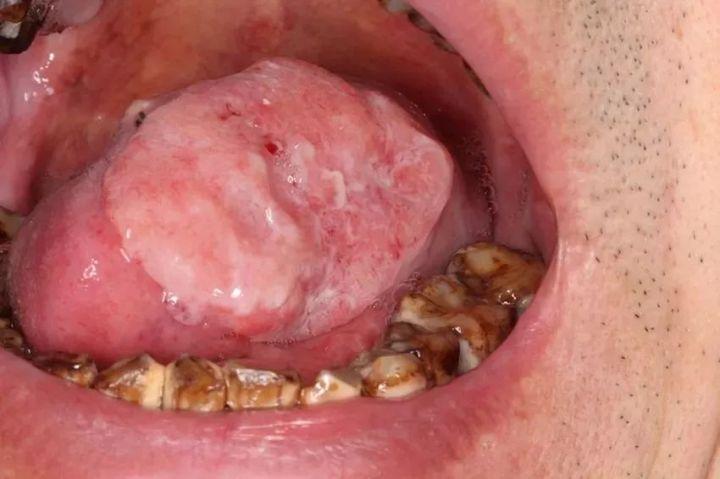 吃槟榔口腔癌征兆图片