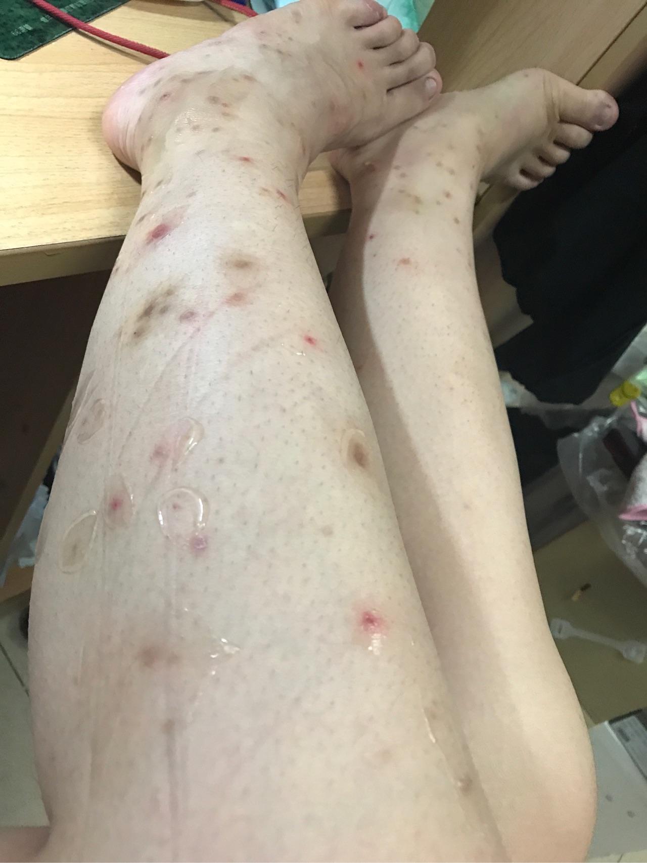 疤痕体质被蚊子咬图片图片