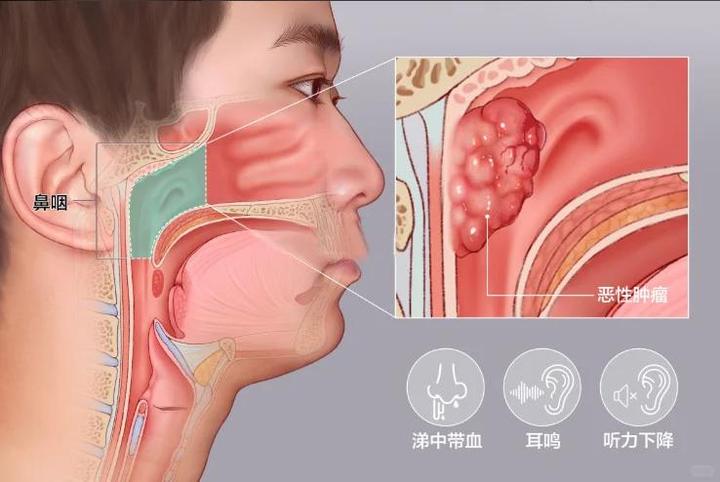 鼻咽癌患者有救啦特瑞普利單抗成就復發轉移性鼻咽癌一線治療新標準