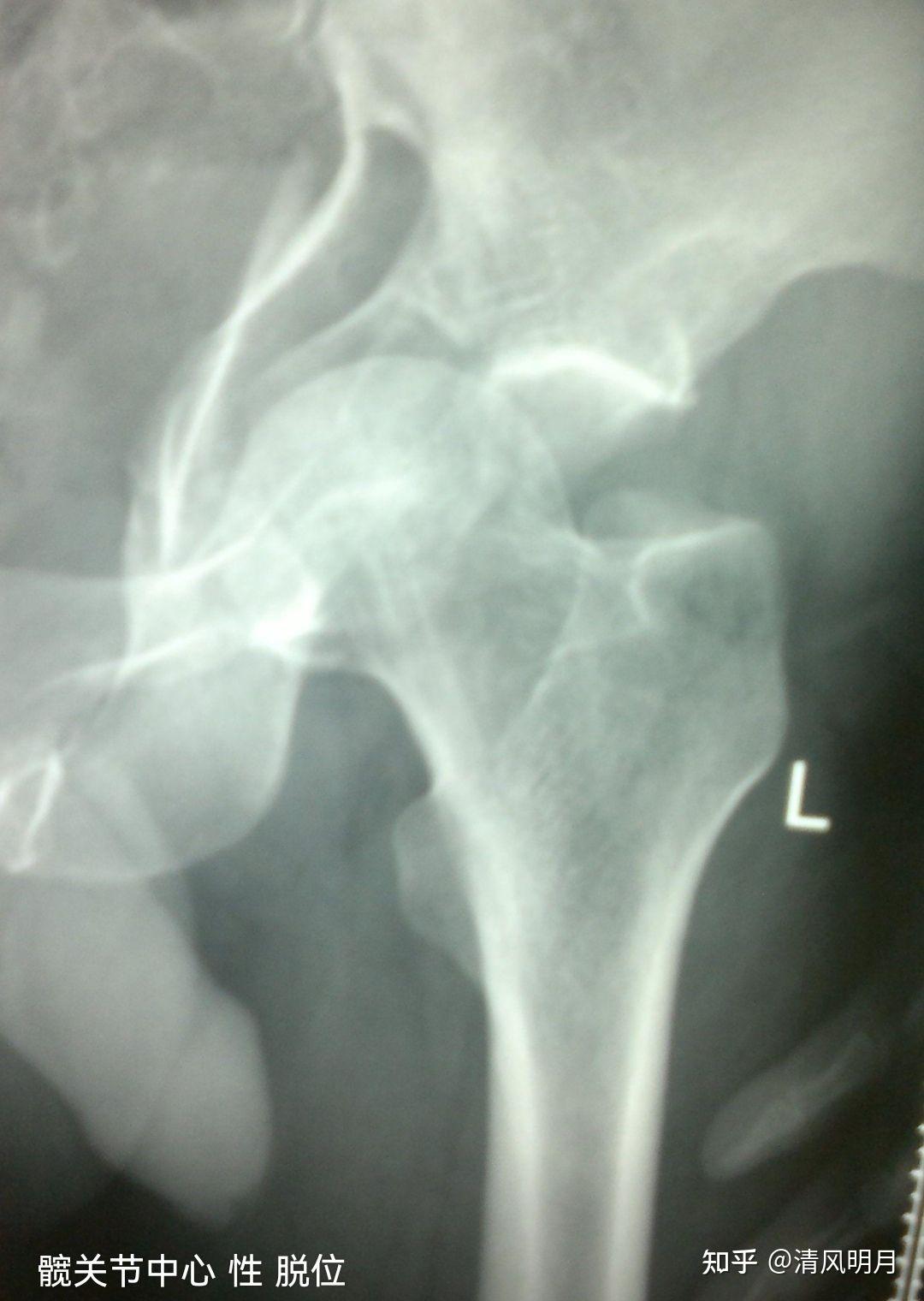 髋关节前脱位的表现症状有哪些?