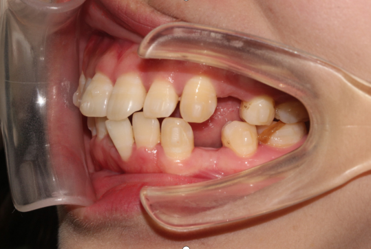 矫正牙齿一定要拔牙吗,这是口腔科的潜规则吗,可以不拔牙吗?