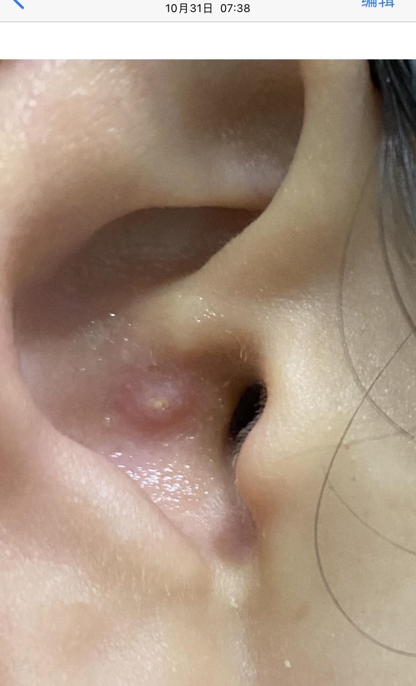 怎样对付外耳道的疖肿