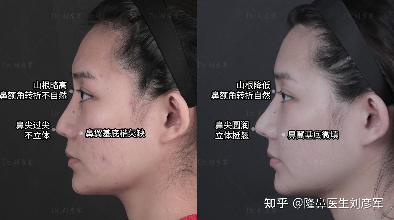 反颌？中上面部凹陷？25岁姑娘挑战全鼻改造，60天后公开改善细节 - 知乎