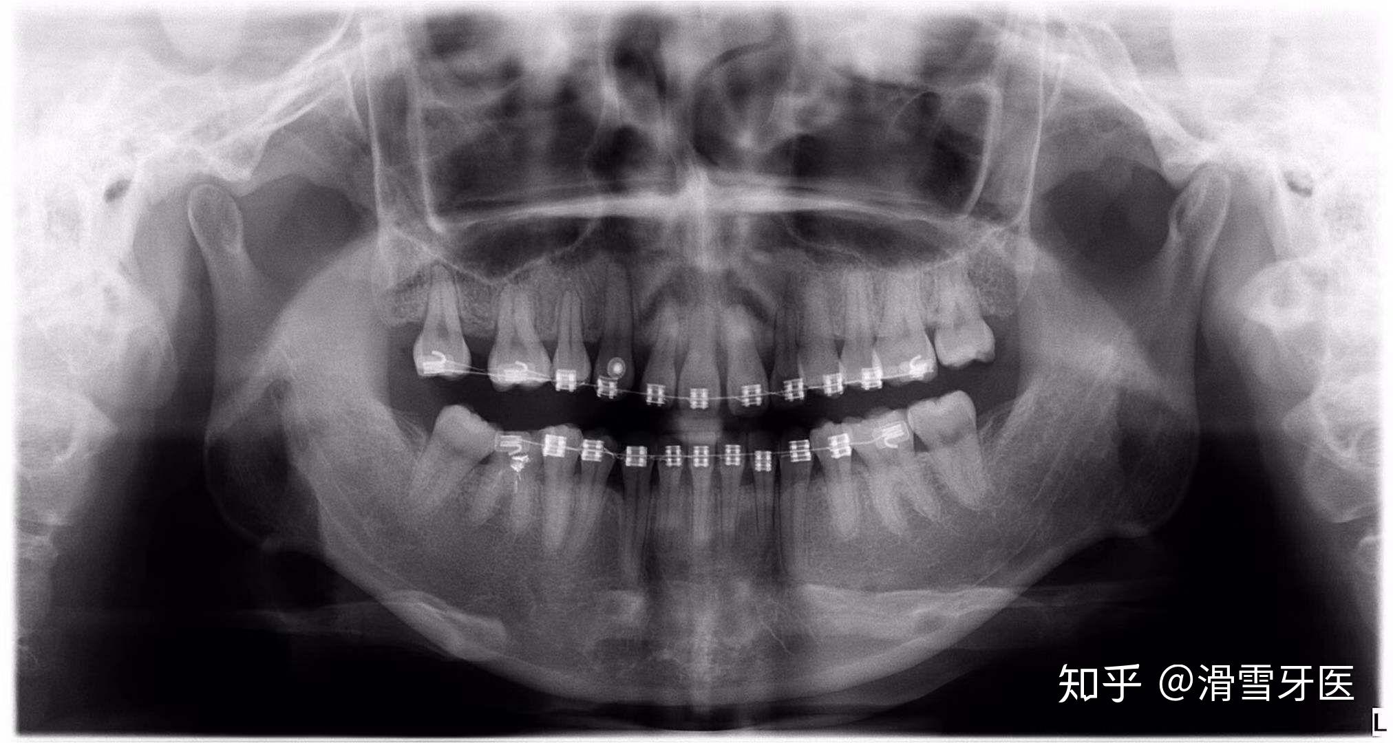 正畸根尖区牙根外吸收的风险因素及其临床处理建议的专家共识