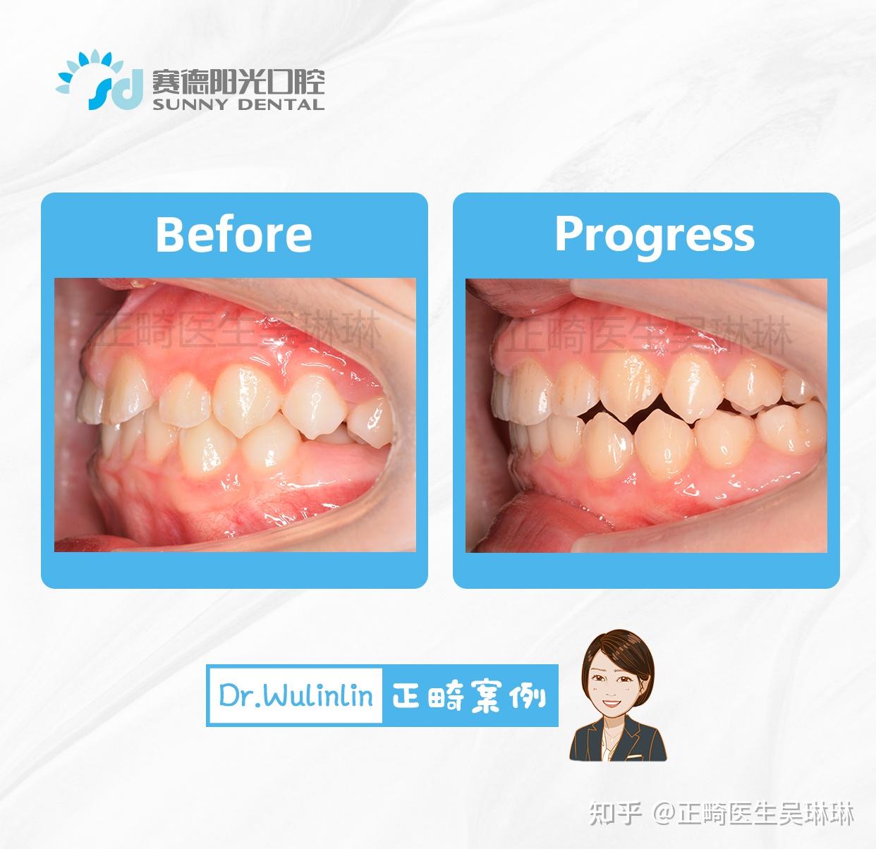 如何看待和矫正锁颌,锁颌是什么,会造成脸部不对称吗? - 知乎