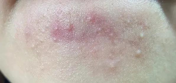 没条件晒被子的时候,尘螨过敏怎么办?