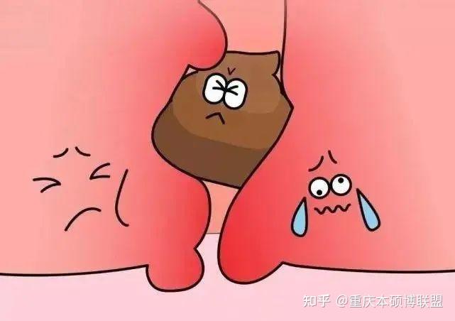 江西景德镇曹元太医生的肛瘘灌注疗法是怎样的? - 知乎